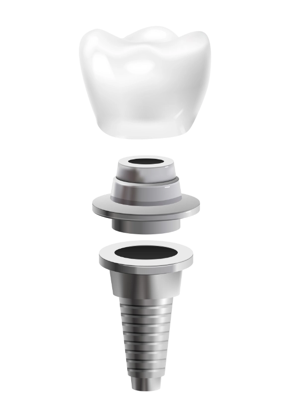 implante dental implante dental